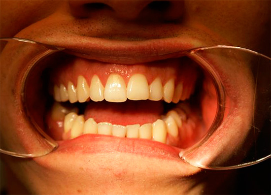 Y así es como se ve el mismo diente después de endobleaching.