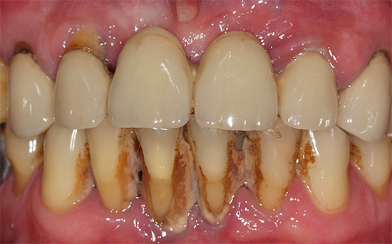 La foto muestra un ejemplo de tartar abundante en los dientes inferiores delanteros.