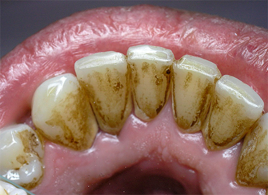 El cálculo dental a menudo se acumula en la superficie interna de los dientes frontales inferiores.