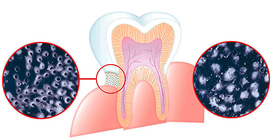 Imaginea arată schematic modul în care sărurile de stronțiu, calciu și fluor pot reduce sensibilitatea dinților, blocând tubulii dentinali.
