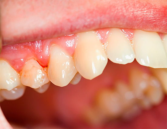 Mexidol Dent Zahnpasten sind in erster Linie auf die Behandlung und Prävention von Zahnfleischerkrankungen (Parodontitis, Parodontitis, Zahnfleischentzündung, etc.) konzentriert
