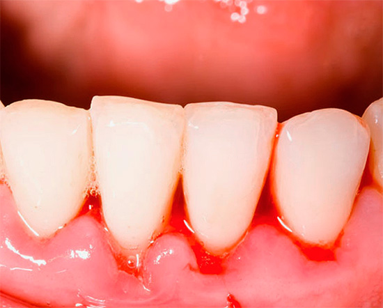 Pâtes dentifrices particulièrement populaires, le pomorin, pour lutter contre l'inflammation des gencives et leurs saignements.