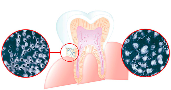 La imagen muestra exactamente cómo el acetato de estroncio ayuda a reducir la sensibilidad dental.