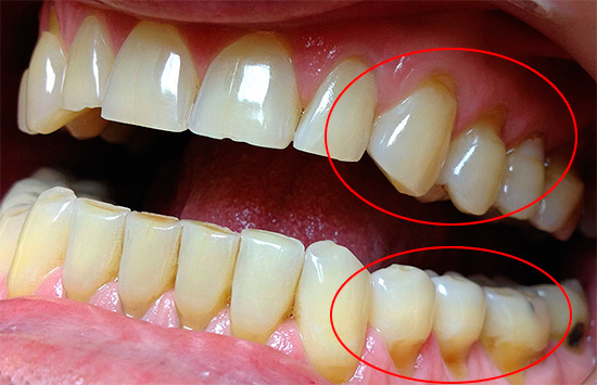 La foto muestra los defectos en forma de cuña en el área cervical, que a menudo causan una mayor sensibilidad de los dientes.