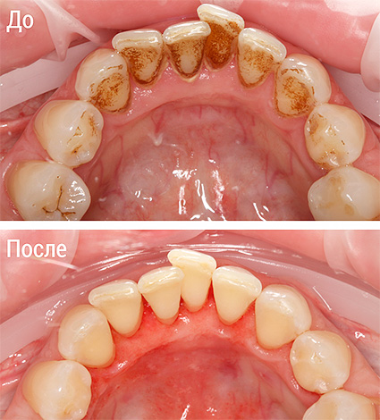 La foto muestra el aspecto de los dientes antes y después del procedimiento de flujo de aire.
