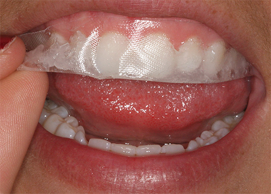 Se aplican tiras blanqueadoras a los dientes en el área de la sonrisa.