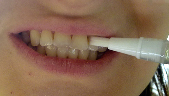 Un ejemplo de la aplicación de un gel de un lápiz blanqueador a sus dientes.
