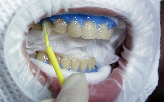 El verdadero blanqueamiento dental implica la destrucción química de los compuestos coloreados que conforman la estructura de la capa superficial del esmalte.
