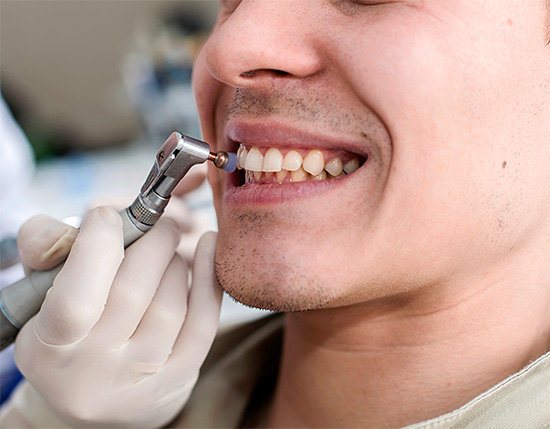 El blanqueamiento mecánico de dientes se denomina más correctamente blanqueo, ya que solo elimina los depósitos manchados de la superficie del esmalte.
