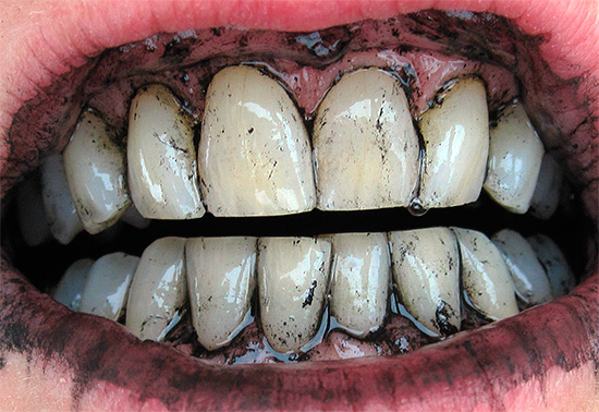 El antiguo método popular de blanqueamiento dental consiste en limpiarlos con carbón ...
