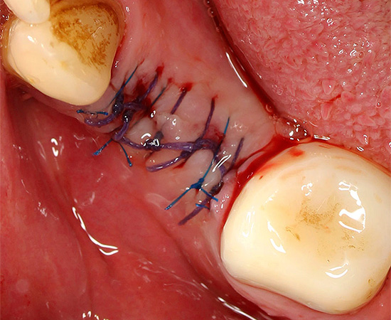 A veces, después de quitar un diente, se colocan puntos de sutura en la herida.