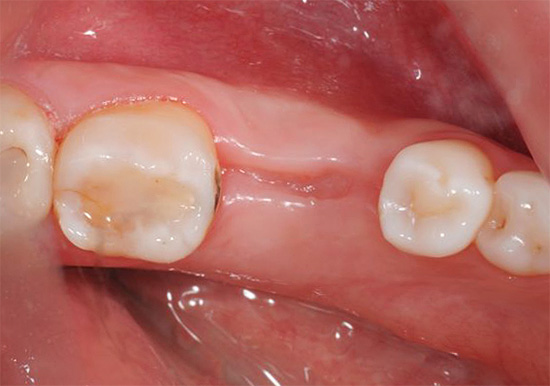 La foto muestra un ejemplo de una encía curada con éxito (3 meses después de la extracción del diente).