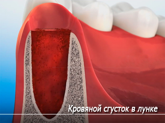 La imagen muestra un coágulo de sangre esquemático en los alvéolos (pozo dental).