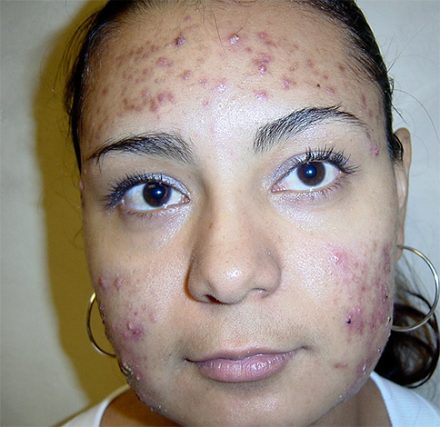 El acné en la cara generalmente ocurre debido a la proliferación excesiva de microorganismos, por ejemplo, en las glándulas sebáceas.