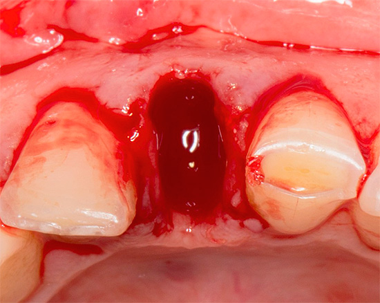 En los primeros días después de la extracción del diente, el enjuague intensivo de la boca es inaceptable, ya que crean el riesgo de que un coágulo de sangre salga del agujero.
