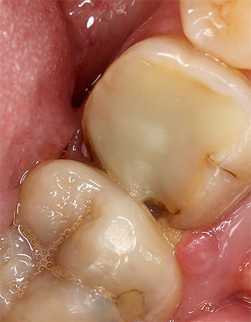 Puede enjuagarse la boca para aliviar el dolor de muelas incluso si tiene problemas graves con los dientes: caries profundas, pulpitis, periodontitis, etc.