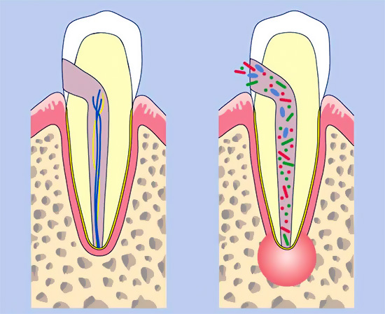 Cuando la pulpitis o la solución de enjuague tibia periodontitis contribuyen a la salida de pus de la fuente de inflamación.