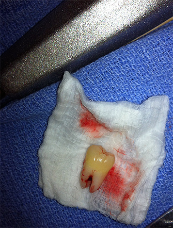 Una vez que se extrae el diente, los cirujanos suelen recetar analgésicos.