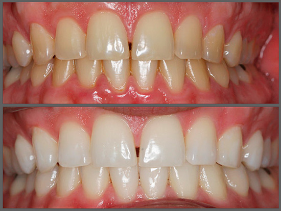 Así es como se ven los dientes antes y después del blanqueamiento.