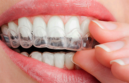 El blanqueamiento casero se puede realizar utilizando tapas individuales hechas en la clínica dental especialmente para usted.