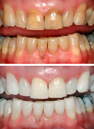 Foto de dientes antes y después del blanqueamiento mediante el método Zoom.