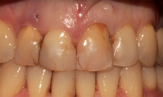 Si hay rellenos en los dientes frontales, luego del procedimiento de blanqueo fotográfico pueden aparecer más oscuros que el esmalte circundante.