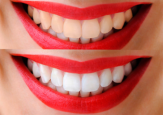 Al blanquear los dientes con foto, es posible aligerar el esmalte en 12 o incluso más tonos en poco tiempo.