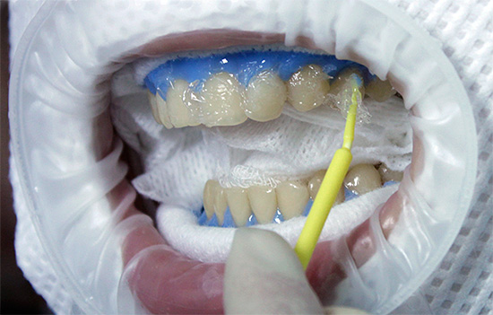 La foto muestra la aplicación de un gel blanqueador en la superficie de los dientes frontales.