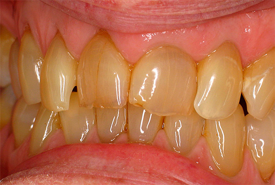 La causa del amarillamiento del esmalte dental puede ser, por ejemplo, fumar, así como el consumo regular de café y té fuertes.