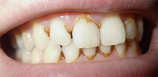 Si ve abundantes depósitos dentales en la superficie del esmalte, entonces es mejor pasar por el procedimiento de higiene oral profesional.