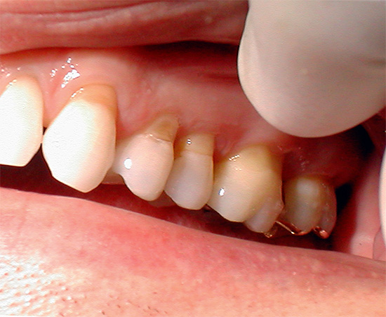 La foto muestra los defectos en forma de cuña - hendiduras en el área cervical de los dientes.