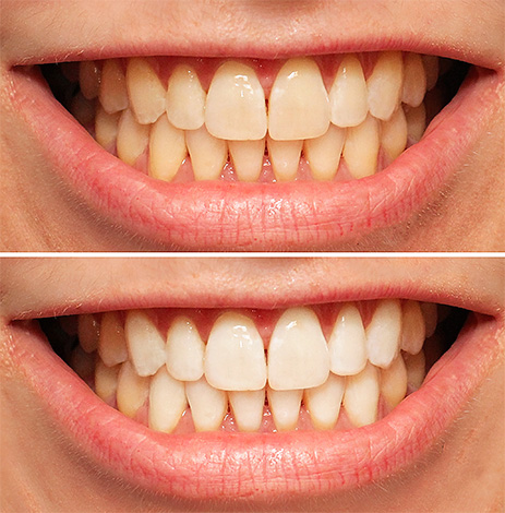 La foto muestra un ejemplo de cómo pueden verse los dientes antes y después del procedimiento de blanqueamiento de fotos.