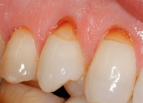El uso de pastas dentales altamente abrasivas puede conducir a la profundización de defectos en forma de cuña.