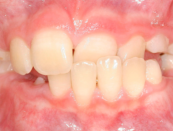 Il existe de nombreux types d'anomalies de morsure de dents - nous en parlerons plus tard et nous en parlerons ...