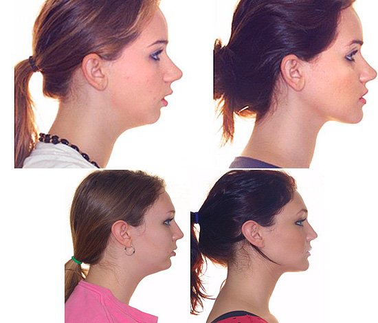 Après traitement (correction) de l'occlusion distale, la forme de la mandibule subit des modifications importantes.