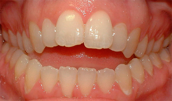 Когато зъбите в предния регион не се затворят, те говорят за открита захапка.