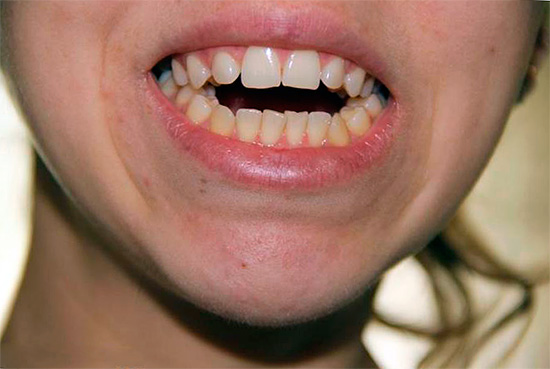 Bei einem offenen Biss ist es oft problematisch, den Mund vollständig zu schließen.