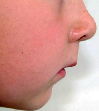 Con una mordida profunda, uno de sus rasgos característicos es un acortamiento significativo del tercio inferior de la cara.