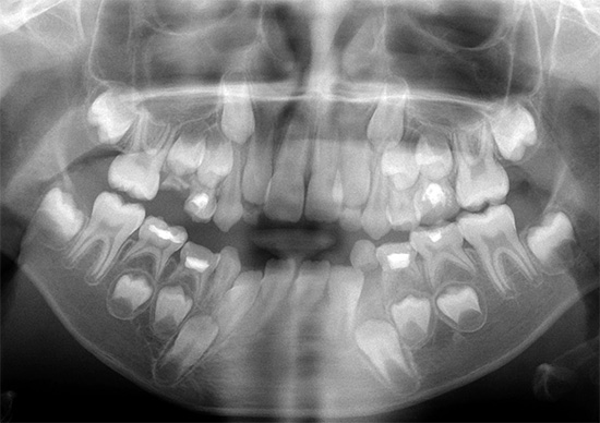 아이의 Orthopantomogram (치과 시스템의 파노라마 이미지).