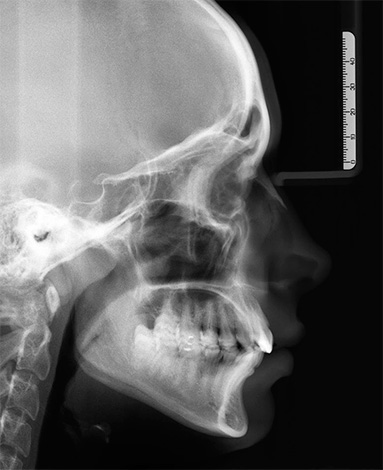 El teleroentograma de la cabeza ayuda al ortodoncista a llegar a una conclusión sobre los motivos del desarrollo de una anomalía de mordida.