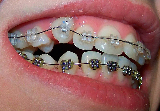 Es ist zu beachten, dass die Korrektur des Bisses mit Hilfe von Zahnspangen sehr viel Zeit in Anspruch nimmt, bis zu mehreren Jahren.