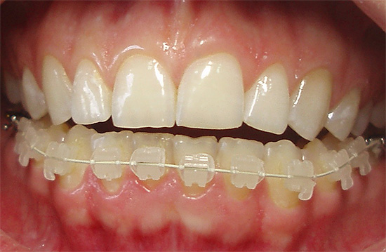 Ein Beispiel für keramische Zahnspangen