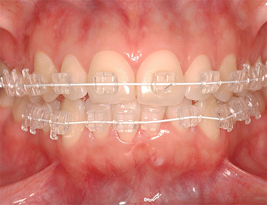 Les bretelles en saphir sont parmi les plus invisibles sur les dents.
