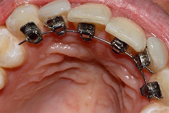 Езиковите скоби са прикрепени към вътрешната (езикова) страна на зъбите, така че те са невидими за другите.