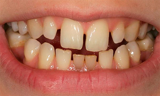 Üç (boşluk) görünmesinin nedeni mikrodentia olabilir - üst üste tek tek dişlerin küçük boyutu.