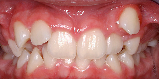 Μερικές φορές ένα δόντι μπορεί να εκραγεί σε ένα άτυπο μέρος για αυτό, το οποίο τελικά οδηγεί στο σχηματισμό ενός ελαττώματος δαγκώματος.
