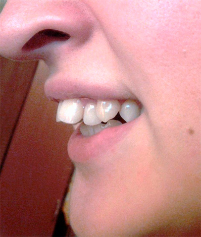 Üst kesici dişlerin dudağa doğru eğimli olduğu bir distal ısırık örneği.