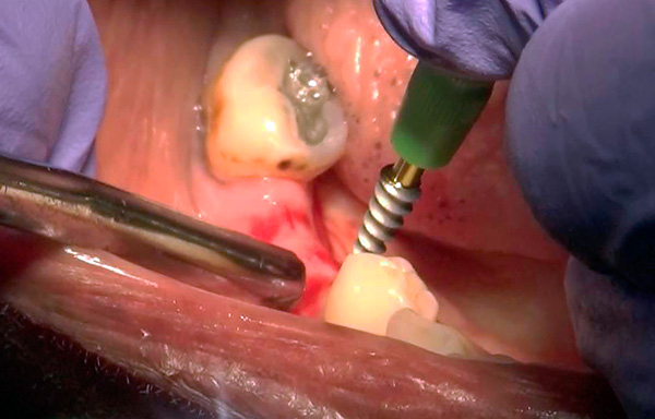 Los implantes basales a menudo se pueden instalar sin cortes significativos en las encías mediante el llamado pinchazo (incisión circular).