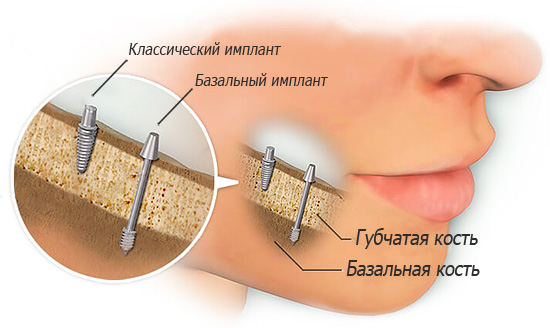 Les implants basaux sont placés dans l'os dense de la mâchoire.