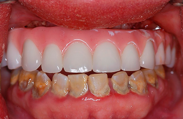 Bazal implantlarda protezler, hastanın ciddi periodontitis ve periodontal hastalık formları olsa bile mümkündür.
